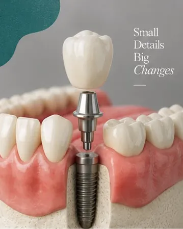 Model implanti dentar, me tekstin Small details, big changes